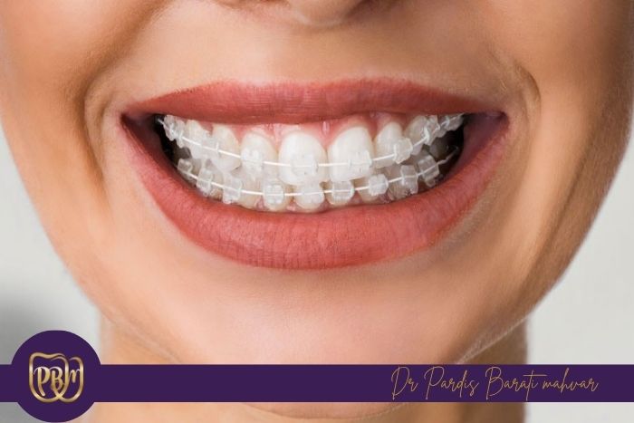  ارتودنسی سرامیکی و ویژگی های آن