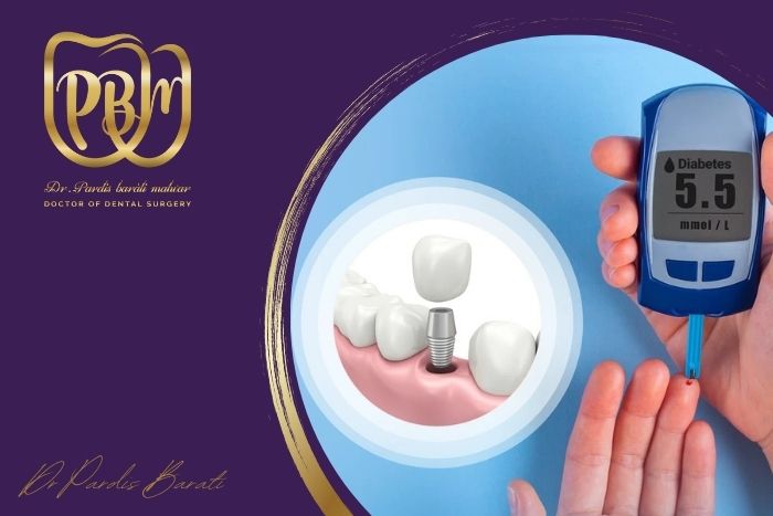 آیا ایمپلنت دندان برای افراد مبتلا به دیابت گزینه مناسبی است؟