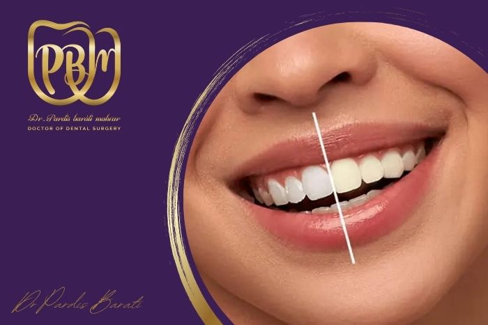 آیا بلیچینگ برای دندان های حساس مناسب است؟
