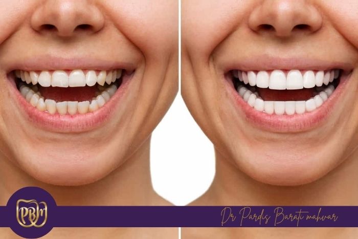 آیا بلیچینگ برای دندان های حساس مناسب است؟