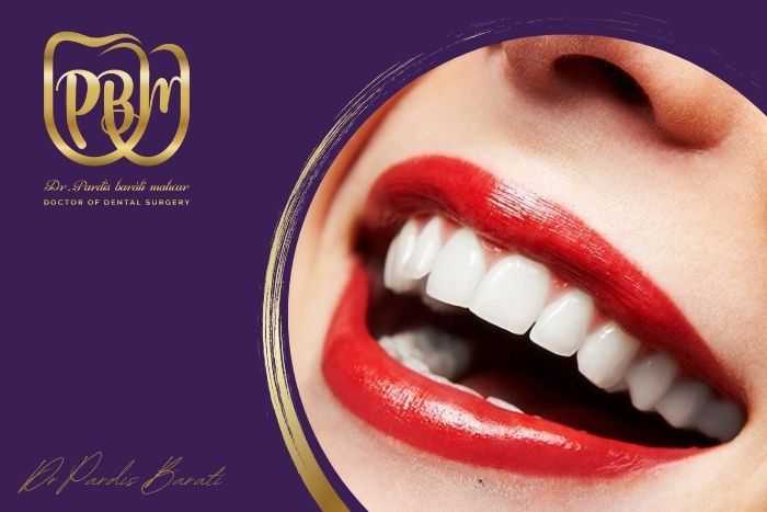 آیا بلیچینگ روی رنگ کامپوزیت یا لمینت تاثیر گذار است؟