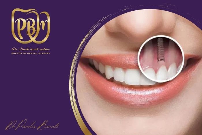 آیا می‌ شود برای دندان‌ های جلو ایمپلنت گذاشت؟ تجربه واقعی بیماران