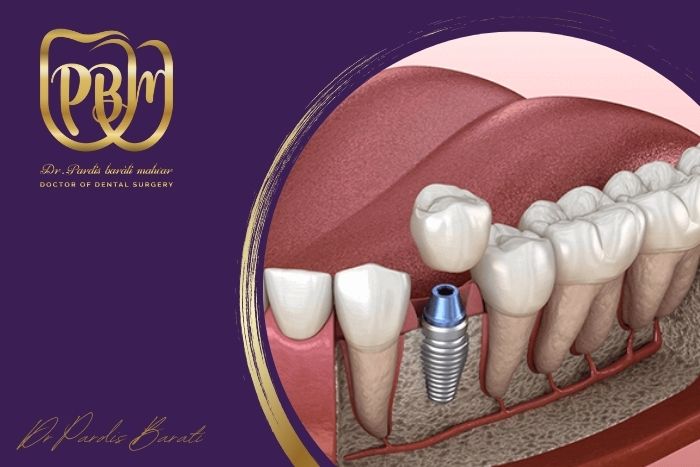استخوان فک شما چقدر باید باشد تا بتوانید ایمپلنت مناسب بگذارید؟