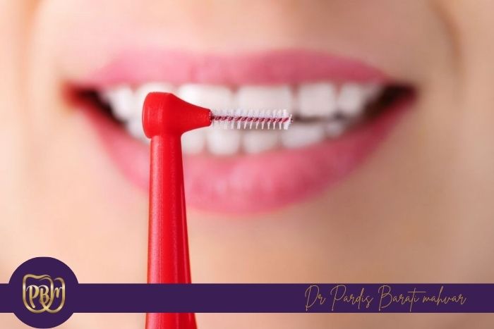 اهمیت مراقبت بعد از ارتودنسی در ماندگاری درمان اهمیت مراقبت بعد از ارتودنسی در ماندگاری درمان