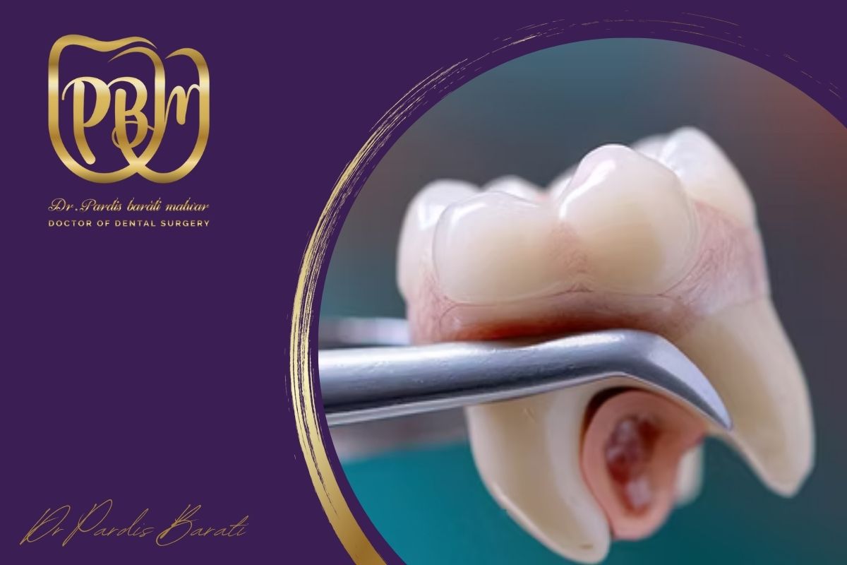 بعد از کشیدن دندان عقل چه بخوریم؟