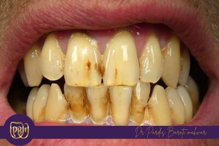 تأثیر سیگار بر تغییر رنگ دندان‌ها