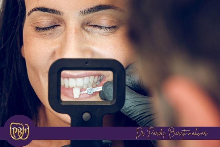 تفاوت لمینت سرامیکی و کامپوزیتی