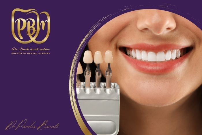 تفاوت‌های لمینت سرامیکی و کامپوزیتی چیست و کدام بهتر است؟