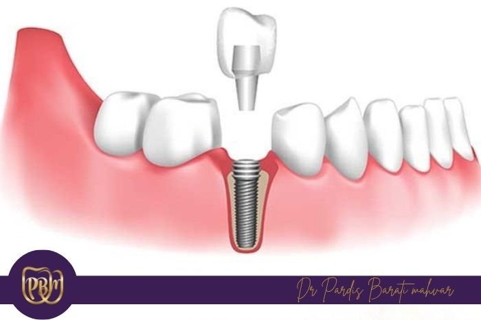 حداقل میزان استخوان فک برای ایمپلنت چقدر است؟