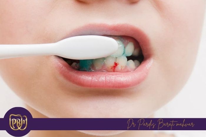 دلایل خونریزی لثه هنگام مسواک زدن