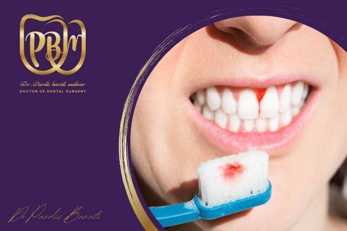 دلیل خونریزی لثه موقع مسواک زدن چیست؟ درمان و پیشگیری
