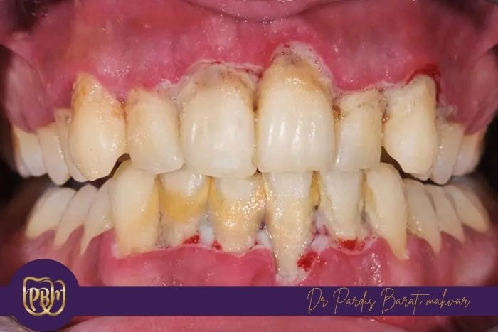 عوارض عدم تمیز کردن فضای بین دندان ها