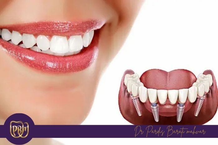 مراقبت‌های بعد از ایمپلنت دندان