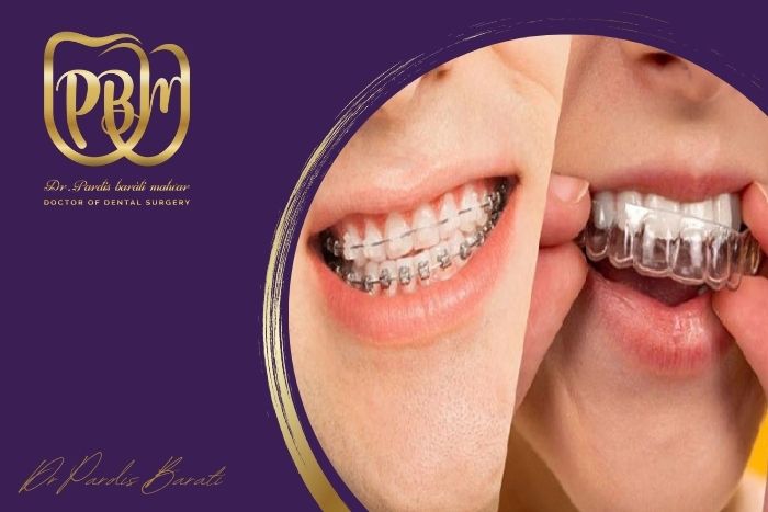 مقایسه انواع ارتودنسی نامرئی: الاینر های شفاف، لینگوال و سرامیکی