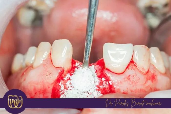 نقش تراکم استخوان در موفقیت درمان