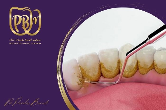 چرا دندان‌ها زود به زود جرم می‌گیرند؟ راهکارهای پیشگیری و درمان