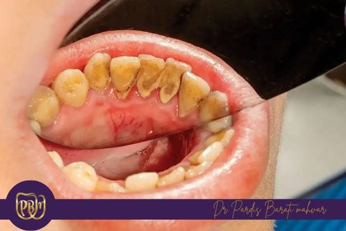 روش‌های مؤثر برای پیشگیری از تشکیل پلاک دندانی