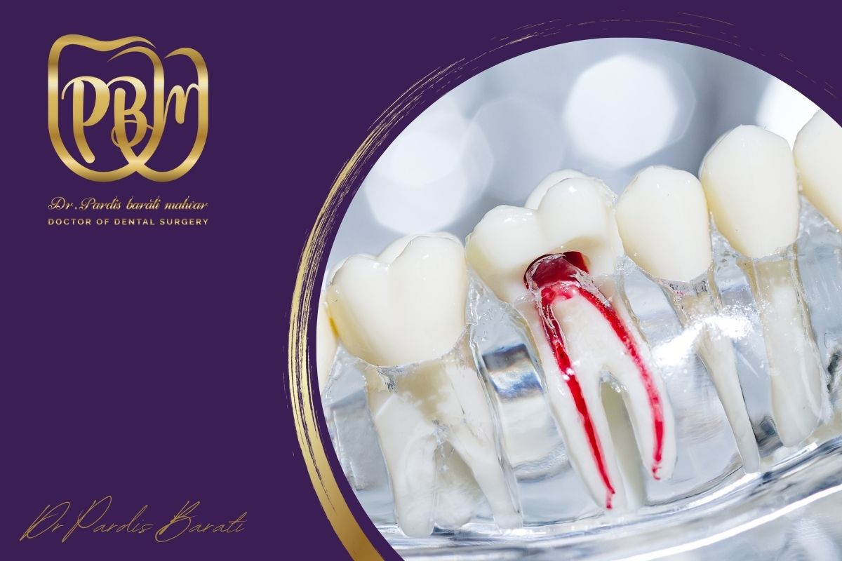 چند روز بعد از عصب‌کشی لازم است دندان را پر کنیم؟