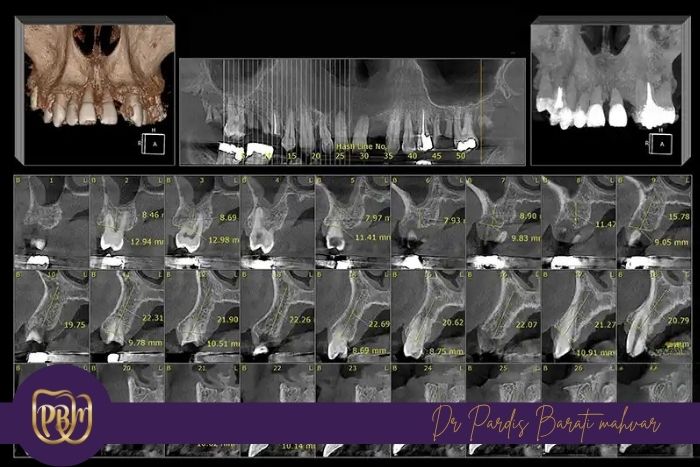 چگونه می‌توان میزان استخوان فک را اندازه‌گیری کرد؟